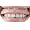 Adjustable Smile Support 2 Pairs Upper & Lower Braces by YYYker-5